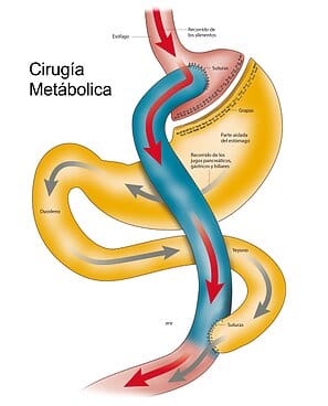 Cirugía Metabólica - Descripción gráfica